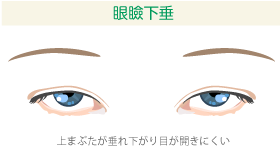 眼瞼下垂