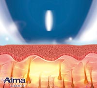 モーションデピアイス